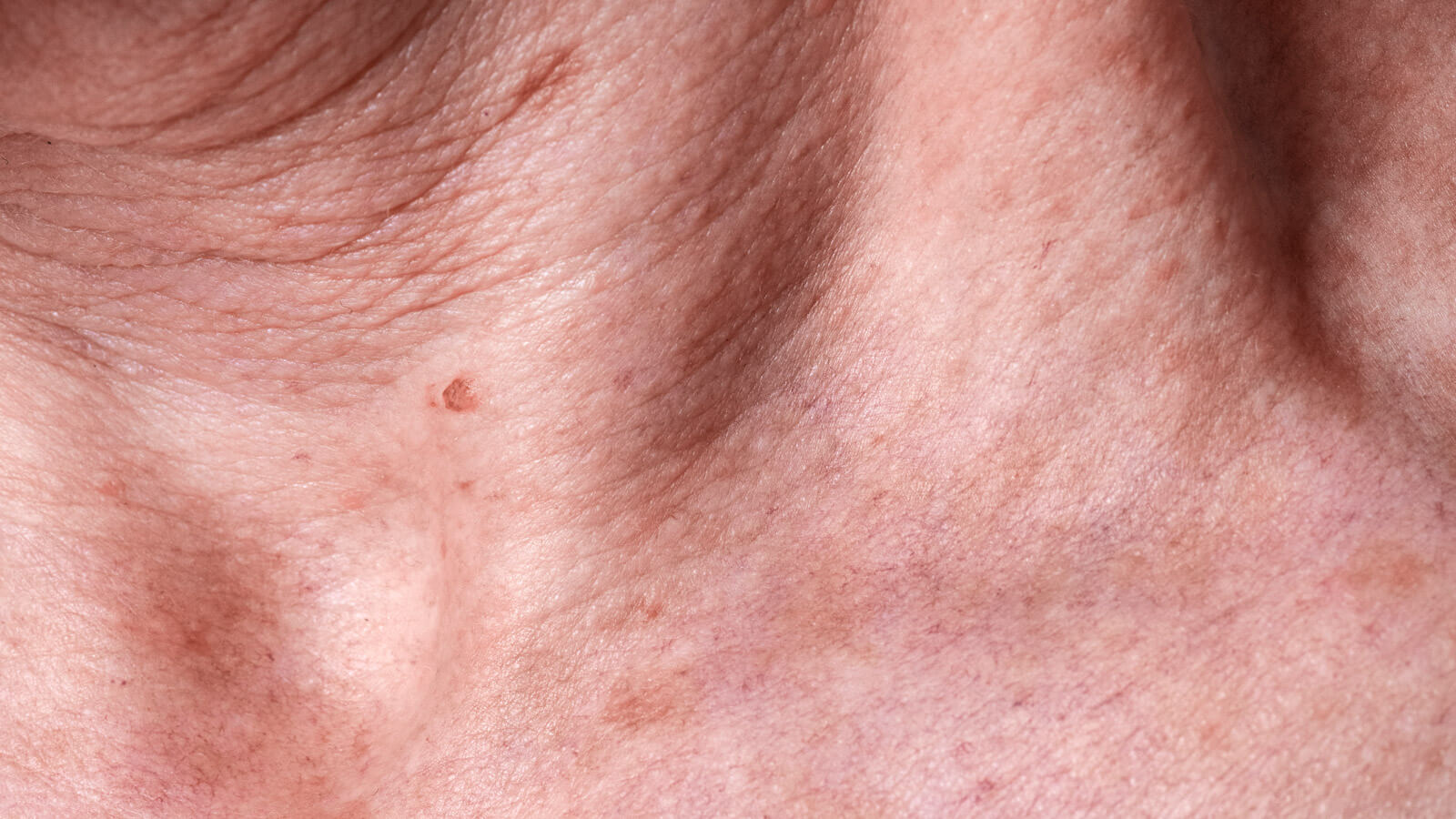 melasma en la piel