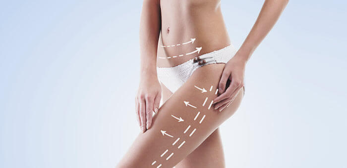 Existe una confusión generalizada entre liposucción y lipoescultura que queremos aclararte