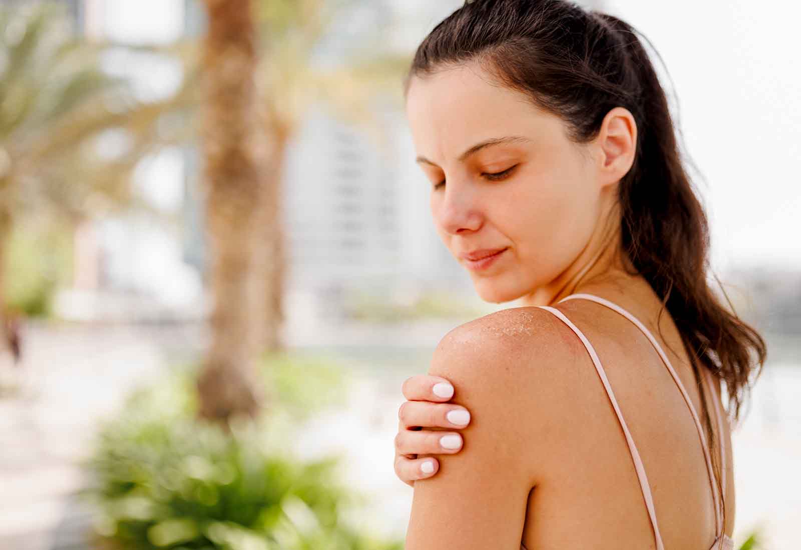 dermatitis solar