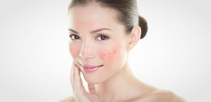 tipos de rosacea