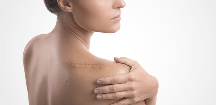 cuidados de cicatrices post operatorias