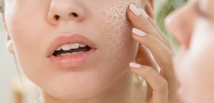 xerosis piel