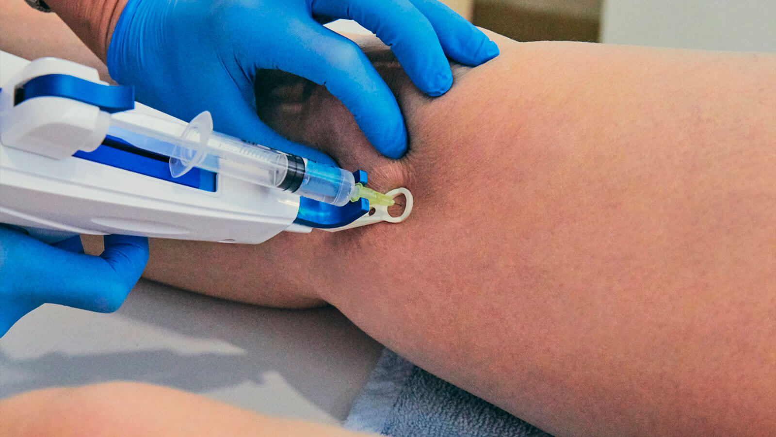 mesoterapia para tratar el lipedema en las piernas