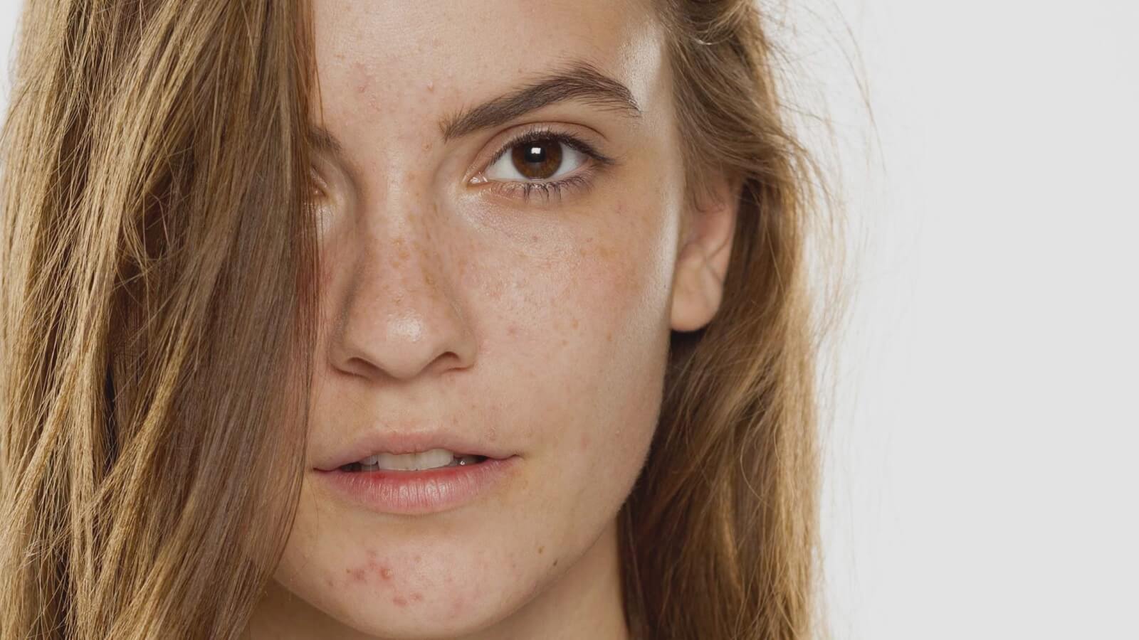 consecuencias del uso de la mascarilla para la piel