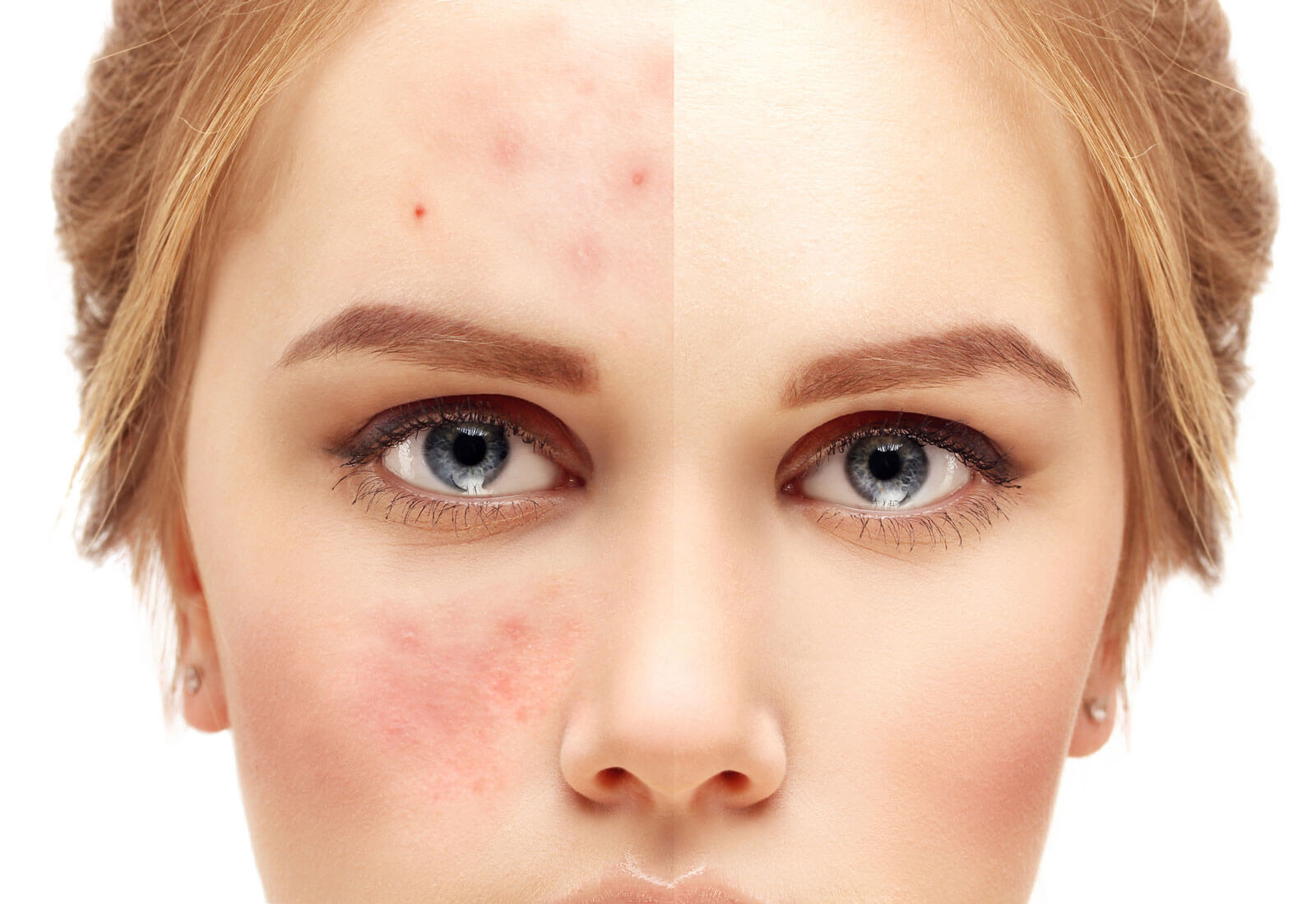 tipos de acne segun la zona