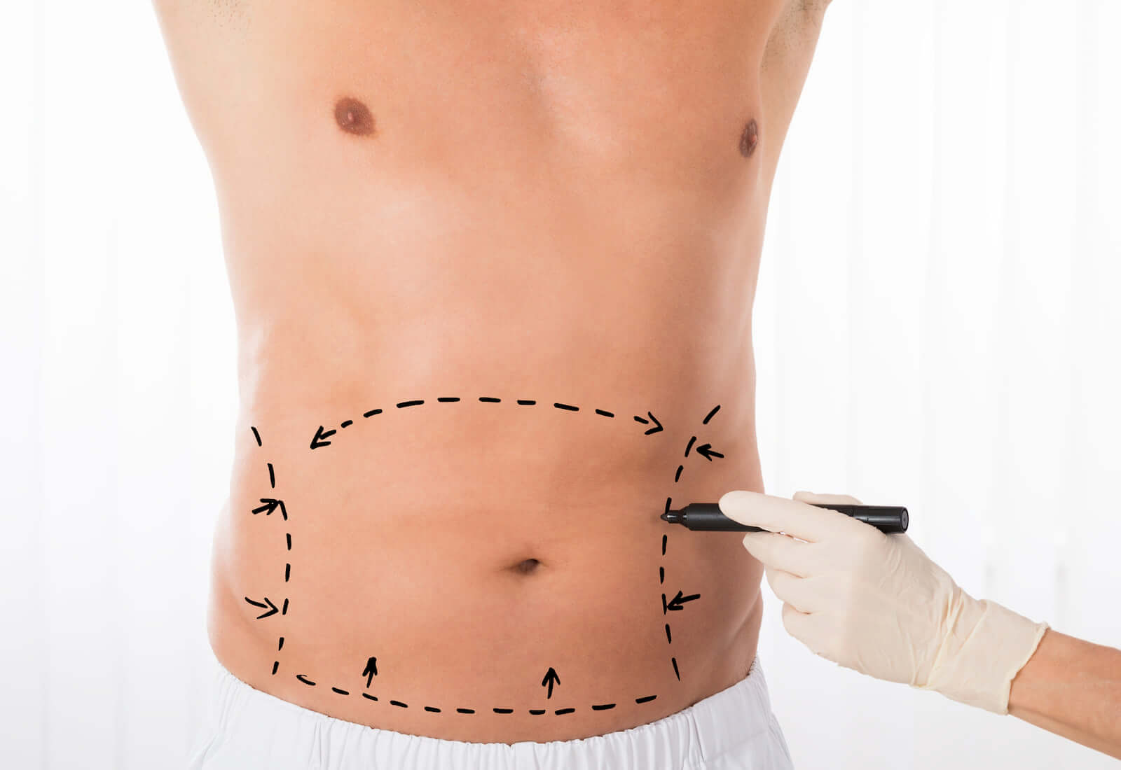 Abdominoplastia nueva cirugía estética