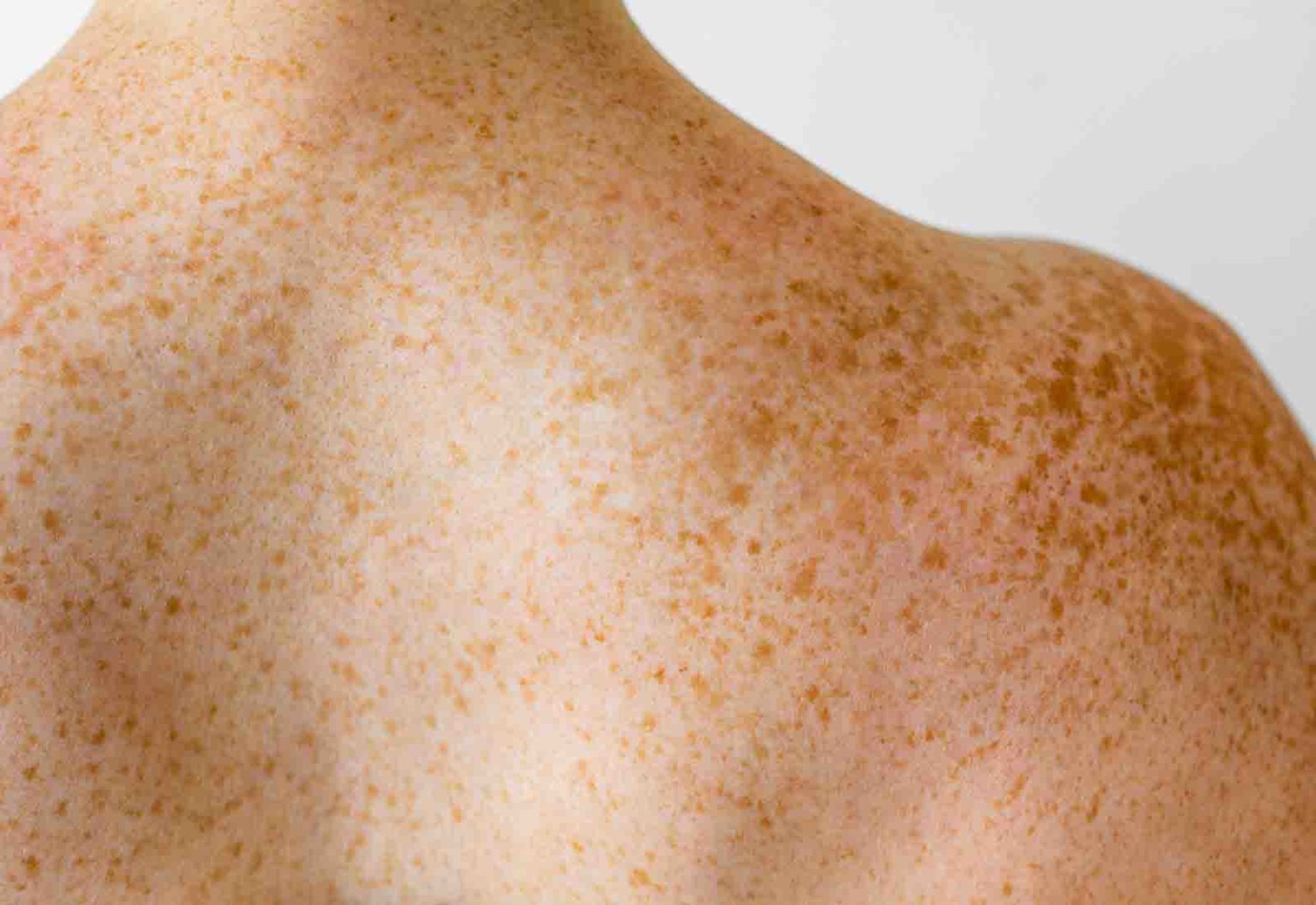 Cómo prevenir las manchas del sol en la piel