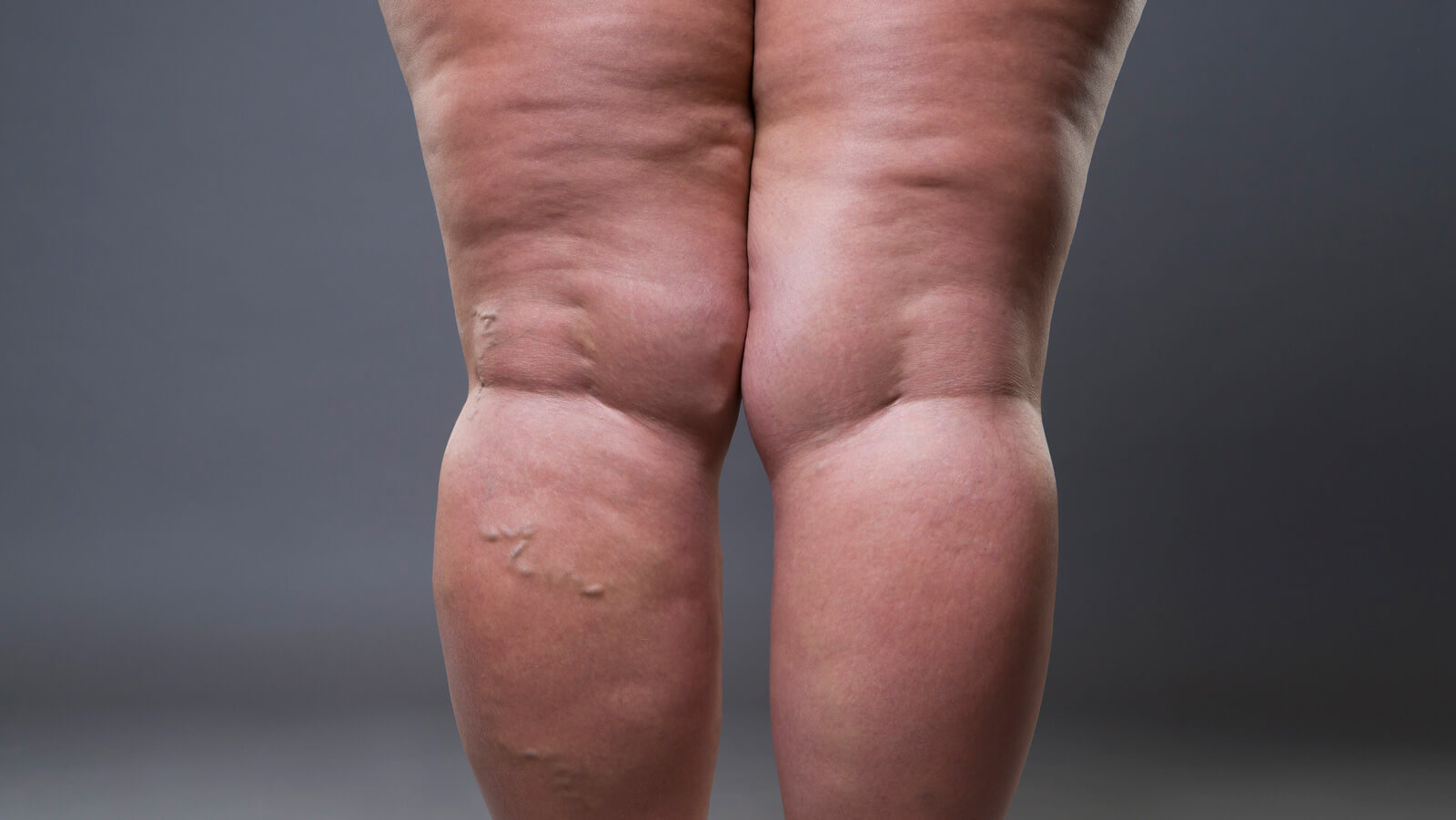 lipedema en las piernas