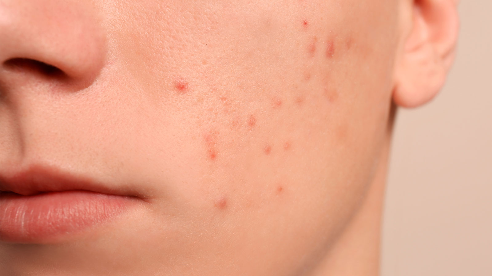 cómo quitar manchas de acné