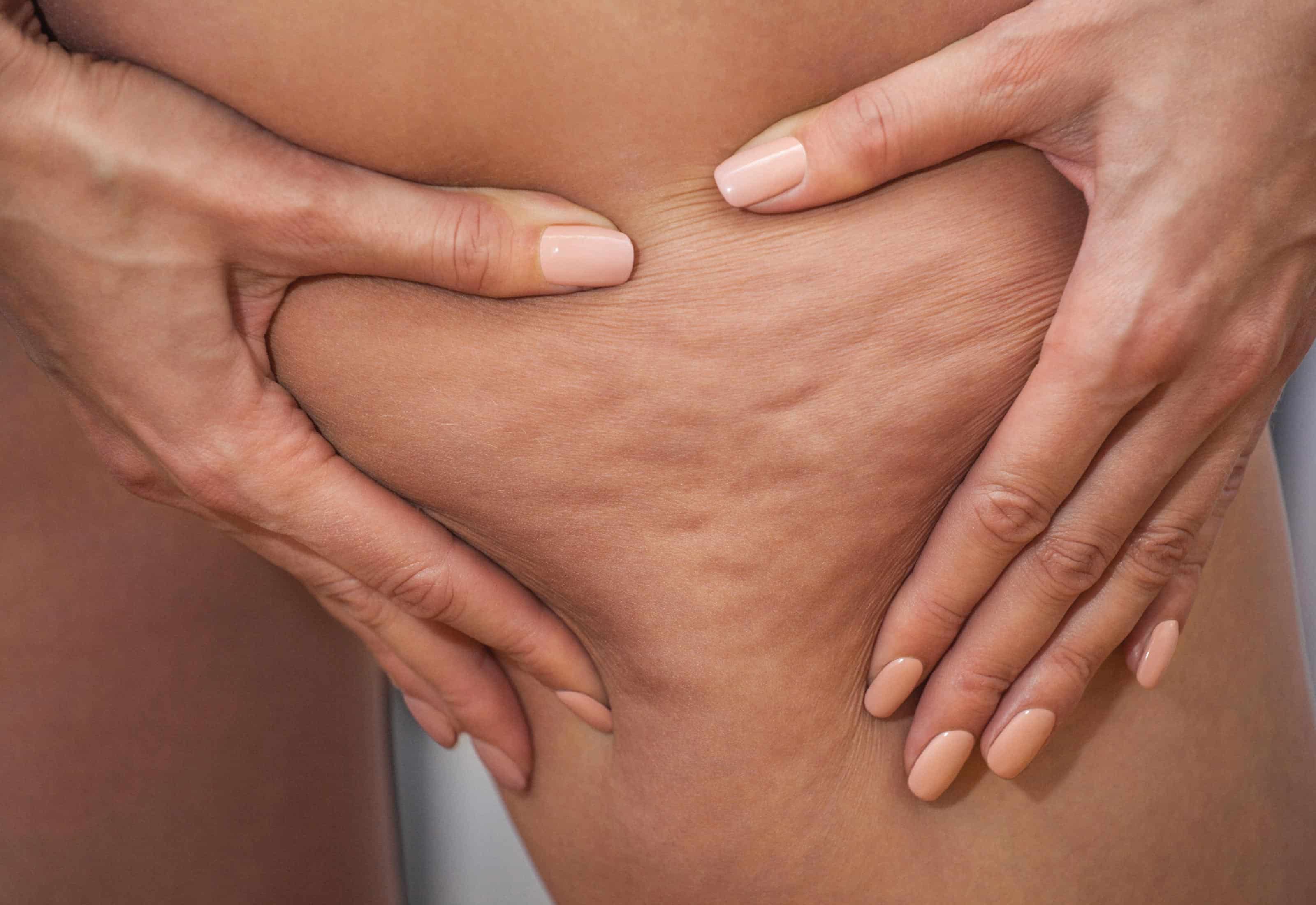 Masaje celulitis gluteos deals