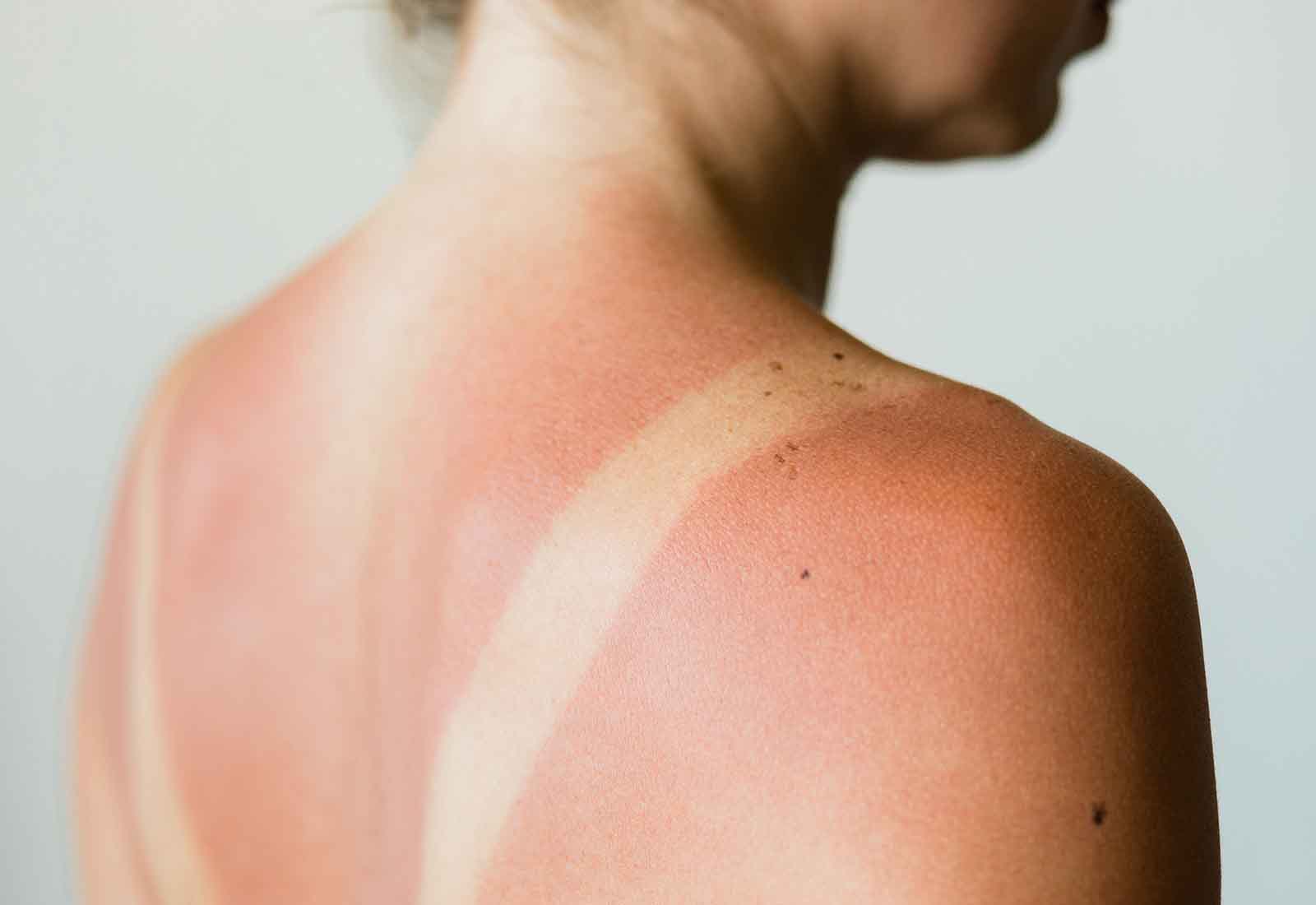 Cuáles son los efectos del sol en la piel