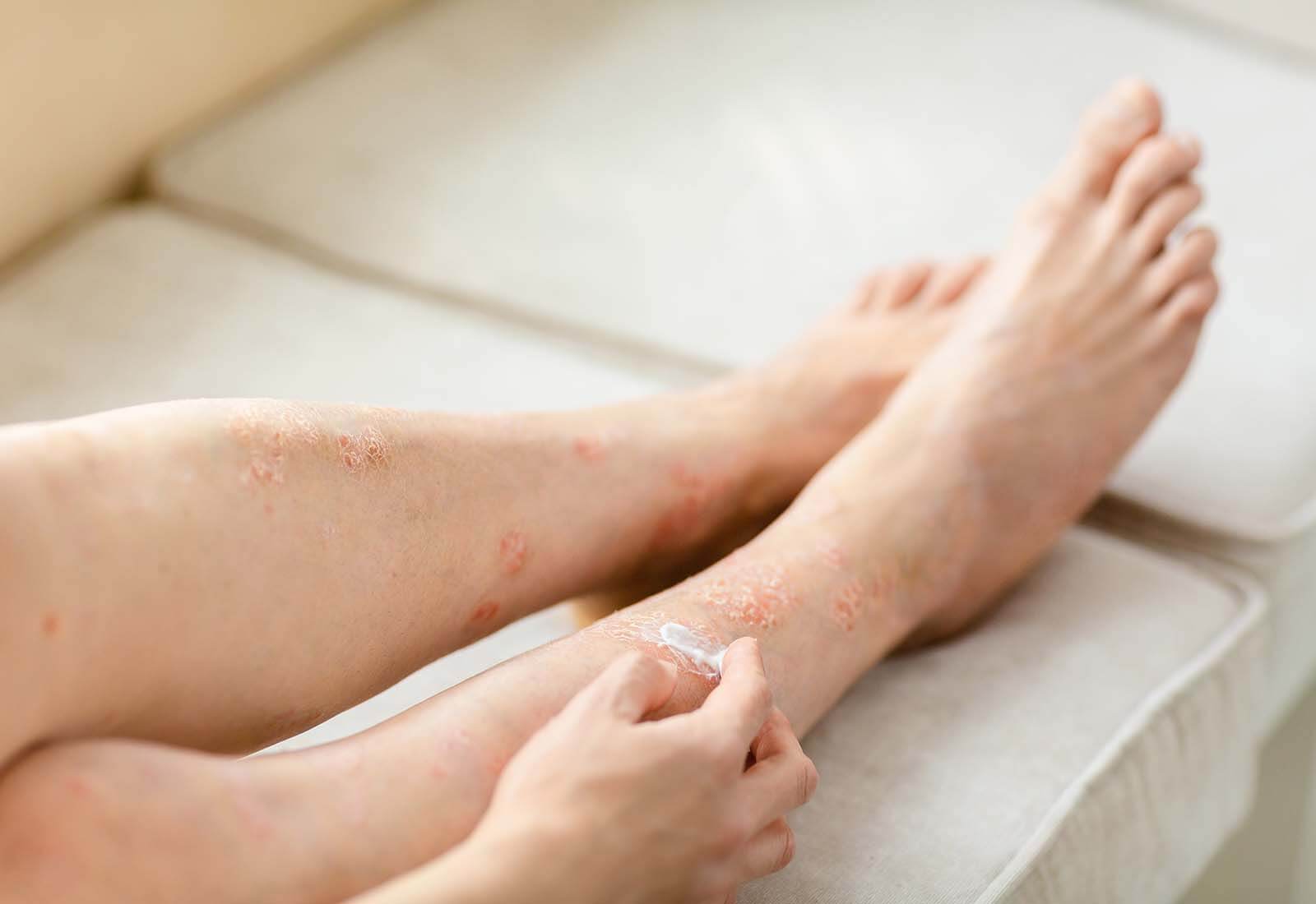 Depilacion Laser y Psoriasis Compatibles